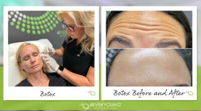 Botox vs. Dysport Aventura