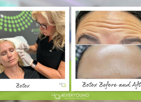 Botox vs. Dysport Aventura