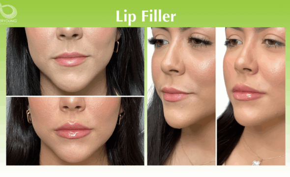  Plump, Smooth, and Define: Lip Filler at 4Ever Young Fort Myers 