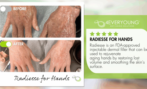 Restore Youthful Hands with Radiesse at 4Ever Young Fort Myers