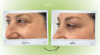 Botox Livingston NJ