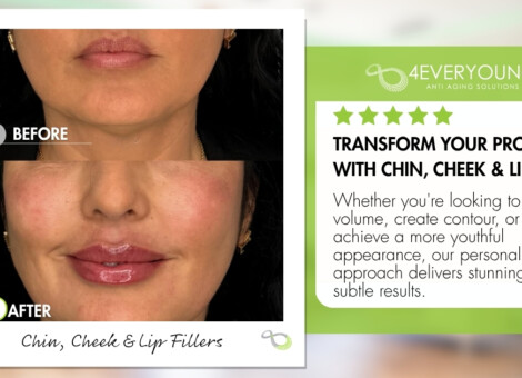 FACIAL BALANCING WITH DERMAL FILLER