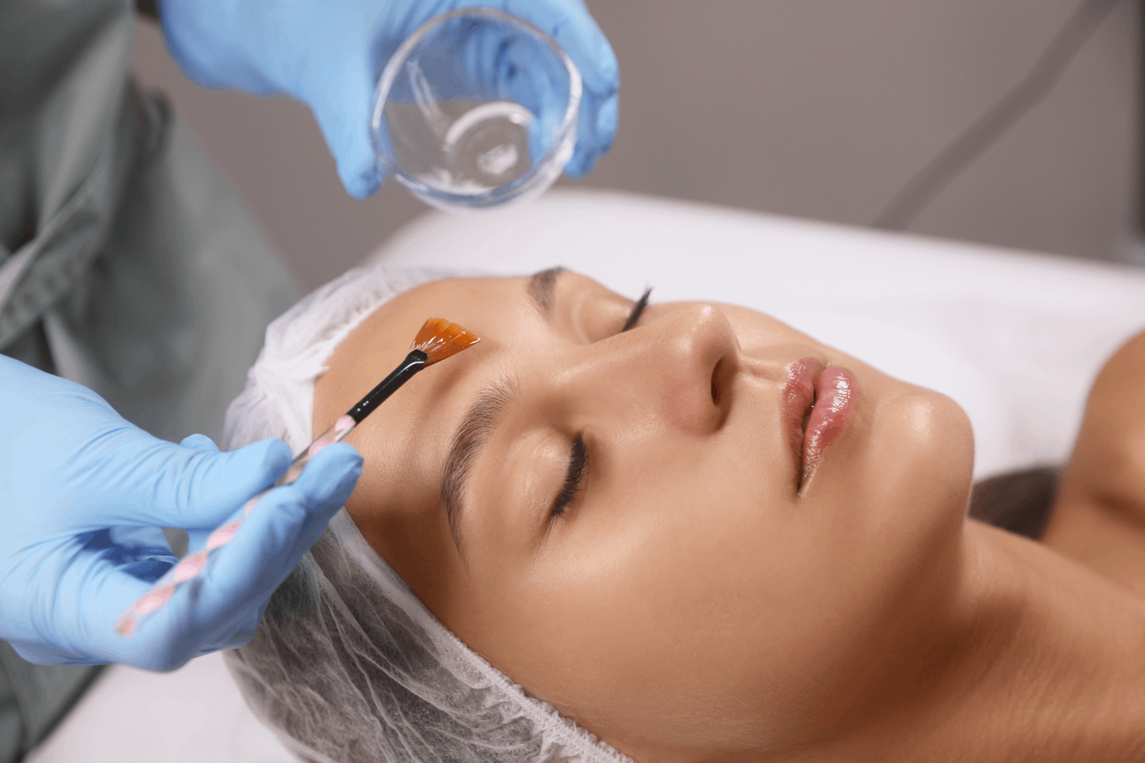 Rejuvenate Your Complexion With a Chemical Face Peel