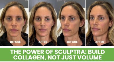 Sculptra Montvale collagen stimulator Montvale Sculptra near me Montvale biostimulator injectable Montvale Sculptra treatment Montvale NJ collagen building injections Montvale 4Ever Young Montvale aesthetics