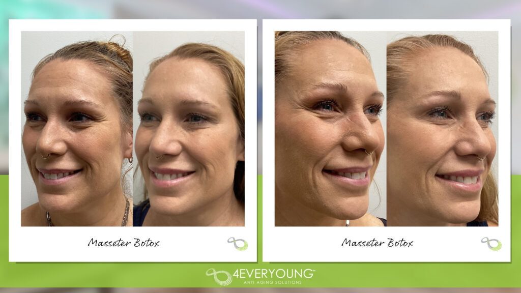 MASSETER BOTOX MT. PLEASANT