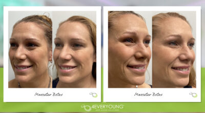 MASSETER BOTOX IN MT. PLEASANT