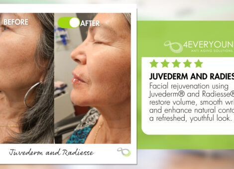 Juvederm Radiesse New Braunfels