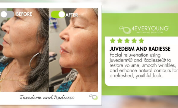  Juvederm & Radiesse in New Braunfels: Natural, Balanced Results 