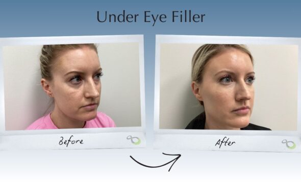  Bright Eyes, Refreshed Look: Under Eye Filler in Newtown, PA 
