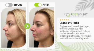 Under eye filler before and after