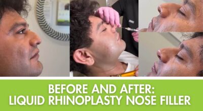 before-and-after-liquiid-rhinoplasty-nose-filler, liquid rhinoplasty Plantation FL, non-surgical nose job Broward, nose filler near me, best injector Plantation FL, profile balancing fillers, dermal fillers for nose Plantation