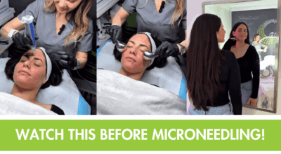 Microneedling in Princeton | Skin Strength & Renewal at 4Ever Young
