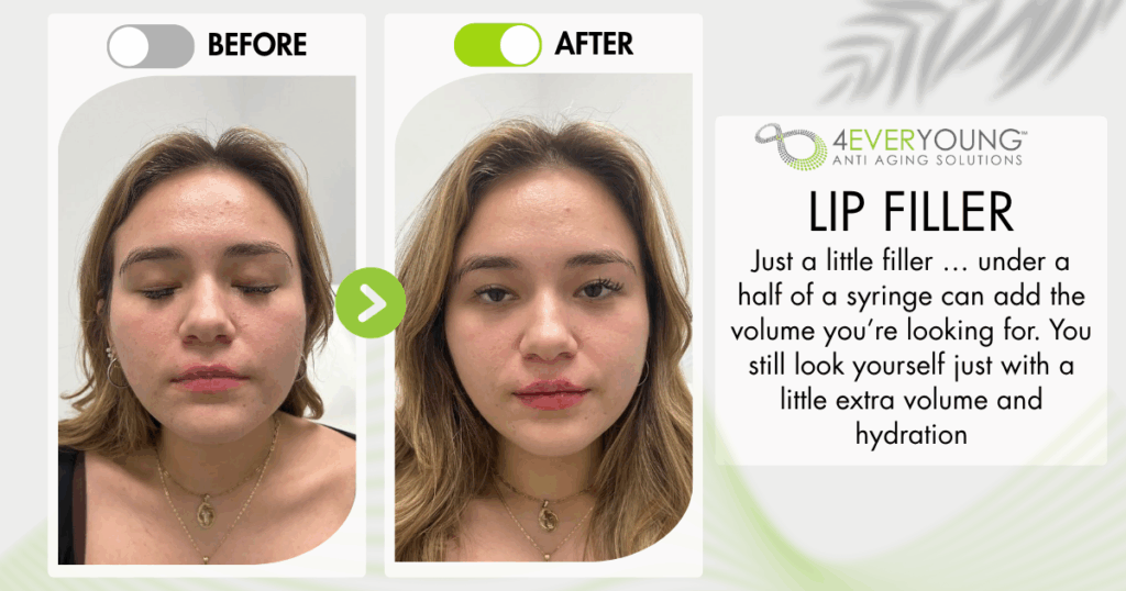 lip filler
