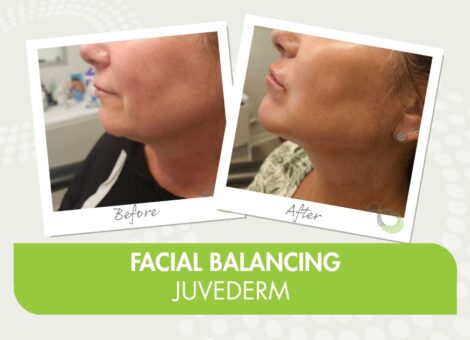 Juvederm 4Ever Young San Antonio med spa