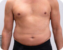 Shirtless man with excess abdominal fat illustrating the body composition that weight loss therapy is designed to address.