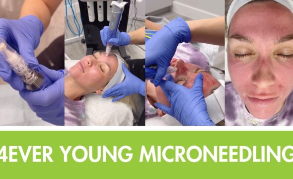  Microneedling Benefits: Collagen Production, Skin Rejuvenation & Acne Scar Treatment 